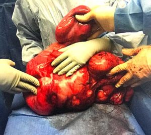 24.7 pound tumor after removal.