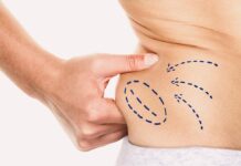 Options for Medical Fat Reduction