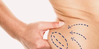 Options for Medical Fat Reduction