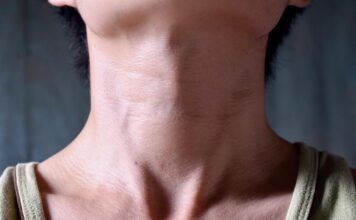 Hypothyroidism