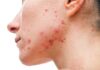 Medical Options for Acne