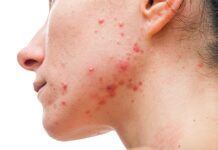 Medical Options for Acne