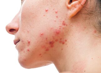 Medical Options for Acne