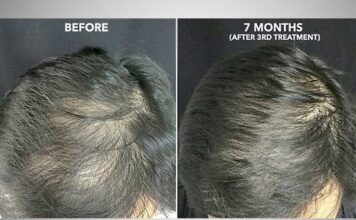 Regenerative Medicine & PRP (Platelet Rich Plasma)