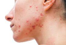 Medical Options for Acne