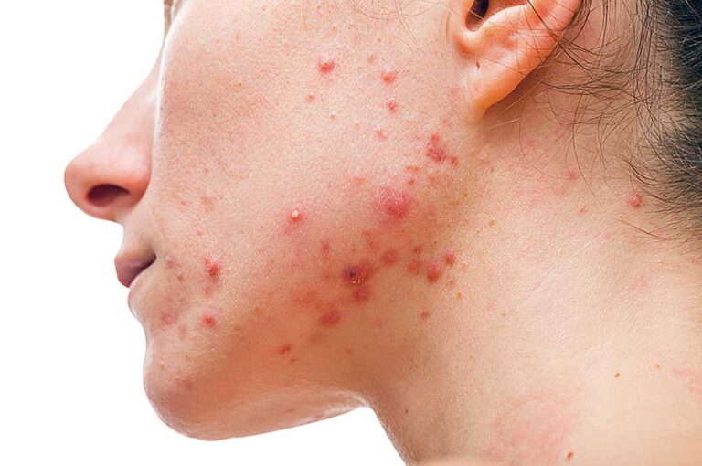 Medical Options for Acne