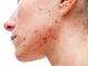 Medical Options for Acne
