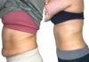 When Diet and Exercise Fail… Real results from only 5 AbSLIM sessions.