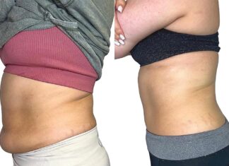 When Diet and Exercise Fail… Real results from only 5 AbSLIM sessions.