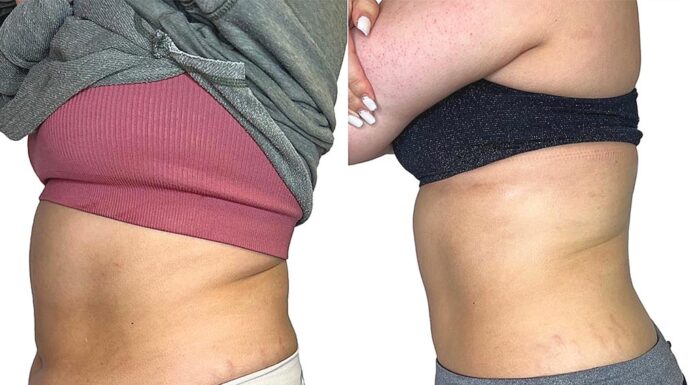 When Diet and Exercise Fail… Real results from only 5 AbSLIM sessions.
