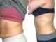 When Diet and Exercise Fail… Real results from only 5 AbSLIM sessions.