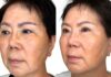 What is Non-Invasive Skin Tightening? skin tightening