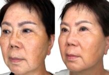 What is Non-Invasive Skin Tightening? skin tightening