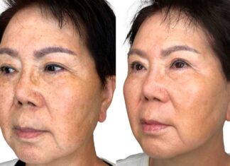 What is Non-Invasive Skin Tightening? skin tightening