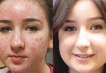 Medical Options for Acne