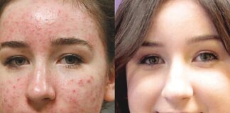 Medical Options for Acne