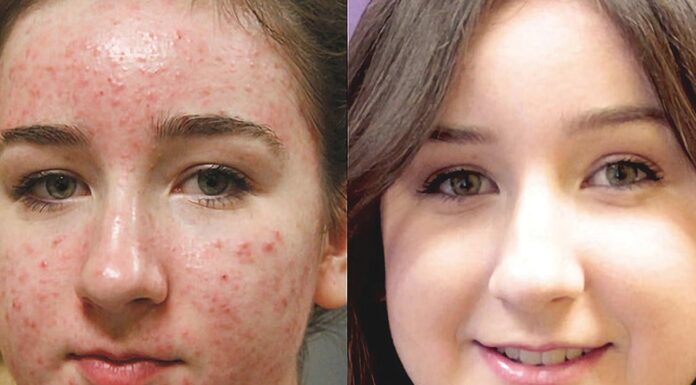 Medical Options for Acne