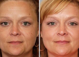 Fall is the perfect time for Broadband Light (BBL) phototherapy