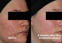 My child has bad acne!  What’s a parent to do?