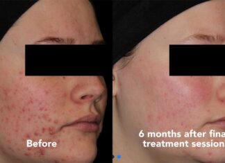 My child has bad acne!  What’s a parent to do?