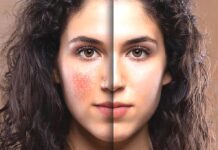 The Power of PRF and Benev Exosomes: Transforming Skin & Hair Health