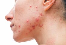 Acne: A Comprehensive Approach to Treatment