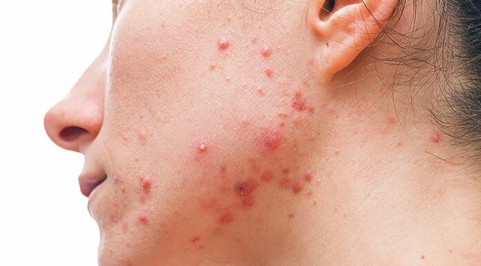 Acne: A Comprehensive Approach to Treatment