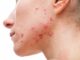Acne: A Comprehensive Approach to Treatment